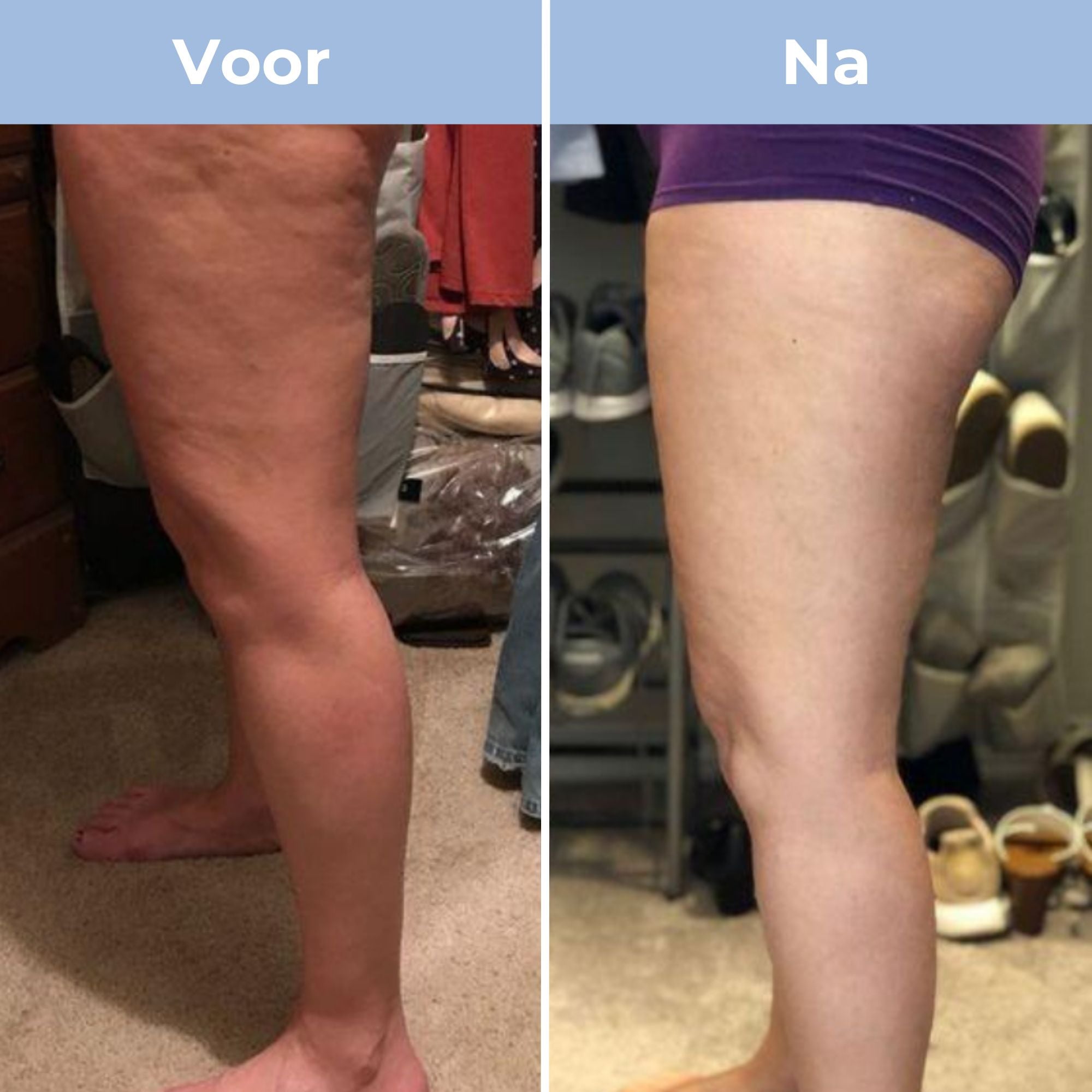 CelluFitPro - Cellulitis verwijderaar