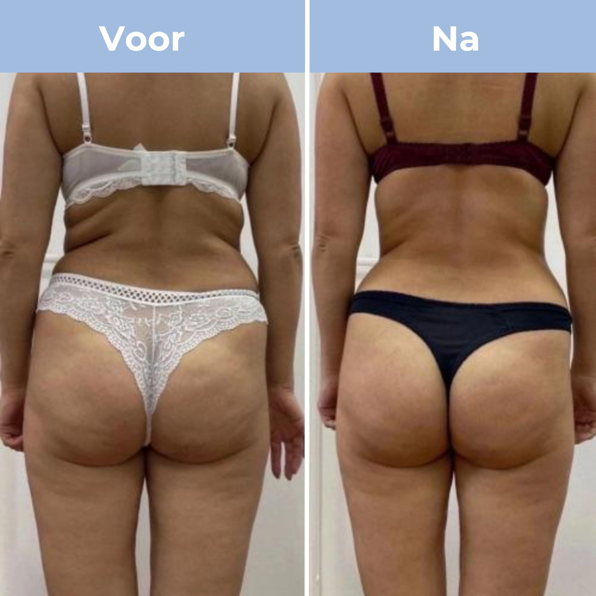 CelluFitPro - Cellulitis verwijderaar